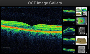 glaucoma